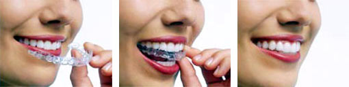 Invisalign - unsichtbare Zahnkorrektur